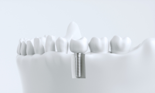 Wszczepienie implantu zębowego